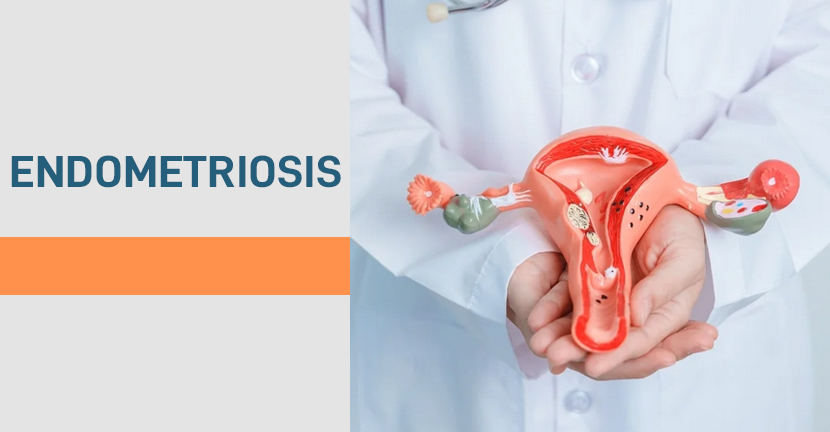 imagen del artículo Endometriosis, en preguntas